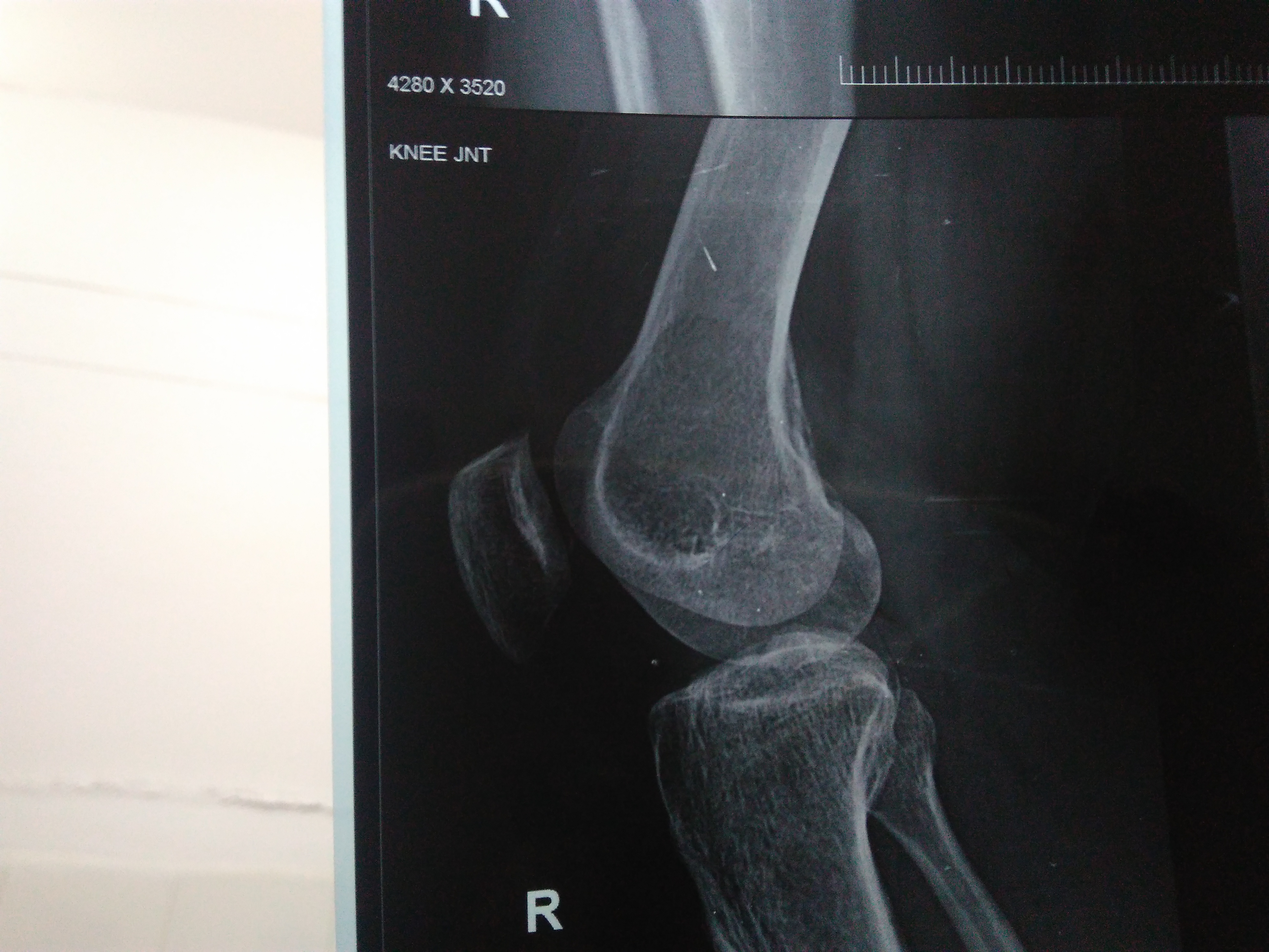 Suggest Management For GCT Distal Femur
